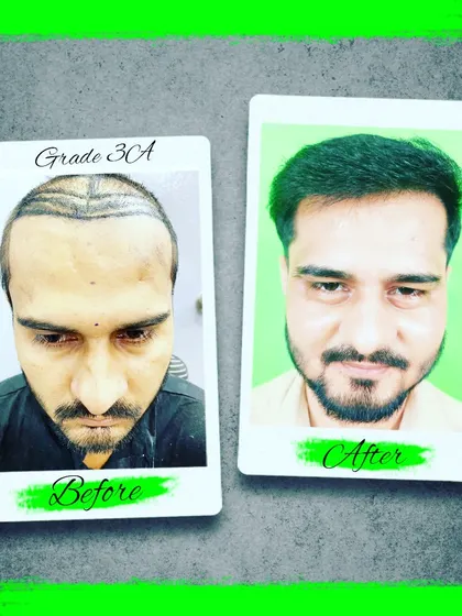 Another successful transformation for a patient with Grade 3A baldness. The before and after images clearly demonstrate the high quality, dense results we achieve.