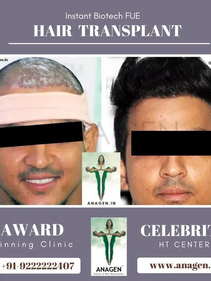 This patient's journey from post op to a full head of hair demonstrates the effectiveness of our Instant Biotech FUE technique.