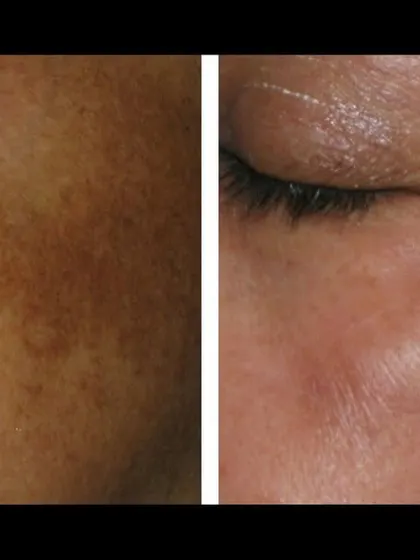 Treating pigmentation on the cheekbones, a common area for sun damage and melasma, requires precision. This result was achieved with targeted laser therapy that broke down the excess pigment without harming the surrounding skin.