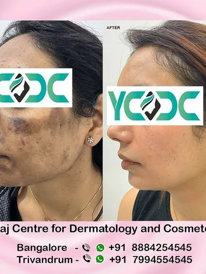 Another successful pigmentation correction case. We focus on not just clearing the marks but also strengthening the skin barrier to prevent future issues, ensuring a lasting, healthy result.