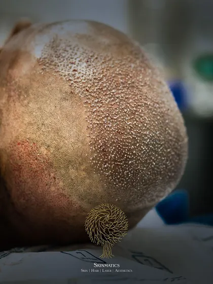 Another angle of the newly implanted grafts. The even distribution and density are key factors in achieving a result that will look completely natural once it grows out.