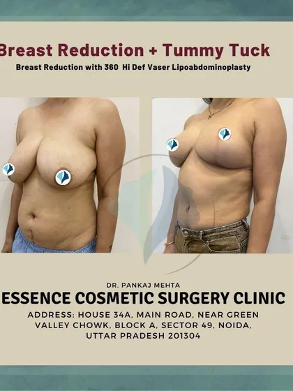 This image shows the transformative result of a Mommy Makeover, combining a breast reduction with a 360 Hi-Def Vaser Lipoabdominoplasty. The 'after' photo displays lifted, more proportionate breasts and a significantly flatter, more toned abdomen.