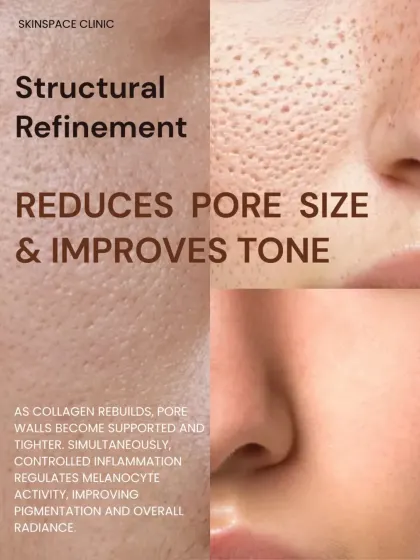 Microneedling provides structural refinement by reducing pore size and improving skin tone. As new collagen supports the pore walls, they appear tighter. The treatment also helps regulate pigment for a more radiant complexion.