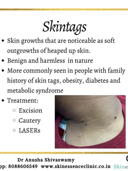 Learn more about skin tags, or acrochordons, with this informational graphic. It details what they are, their link to factors like genetics and metabolic conditions, and the professional removal procedures I use, including excision, cautery, and lasers.