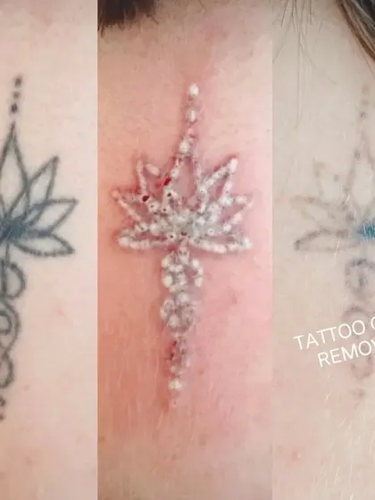 This image shows the complete tattoo removal journey for a lotus design. You can see the original tattoo, the 'frosting' effect immediately after a laser session which is normal, and the final faded result after healing.