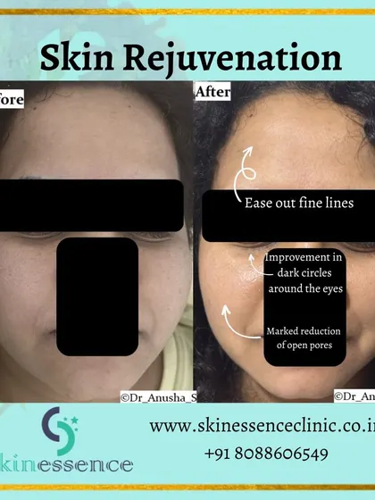 This before-and-after photo is a testament to the power of skin resurfacing. The treatment resulted in a marked reduction of open pores and a visible softening of fine lines, creating a smoother, more refined skin texture.