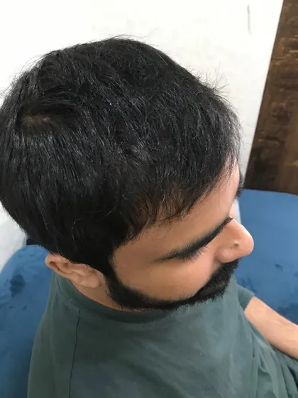 A look at the natural and dense result of a hair transplant procedure performed at our studio. A hair transplant is a permanent procedure that can reverse hair loss and restore your hairline, giving you a renewed look and feel.