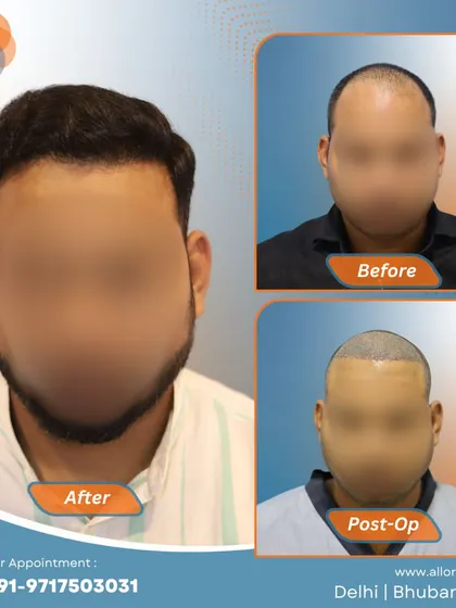 Another complete journey from before to post-op to a fantastic final result. This visual story demonstrates the effectiveness and predictability of my FUE hair transplant technique.