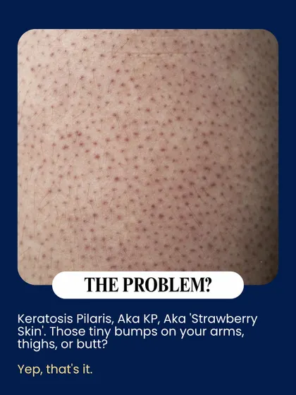 This image shows a close-up of Keratosis Pilaris, also known as 'strawberry skin'. These tiny bumps on the arms, thighs, or buttocks are a common concern, and I offer treatments to help smooth the skin's texture.