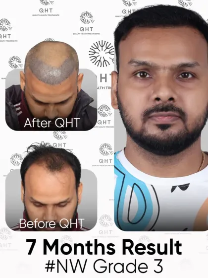 A 7-month result for a Norwood Grade 3 patient. The transformation from baldness to boldness is clear to see.