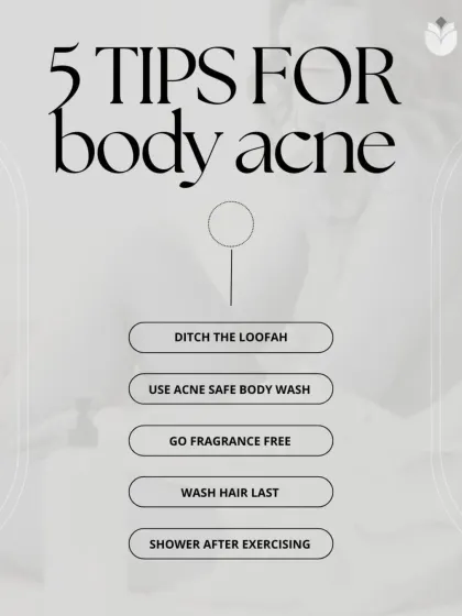 Simple lifestyle changes can significantly help manage body acne. This graphic provides five actionable tips, including using the right body wash and avoiding pore-clogging habits, to complement our clinical treatments.
