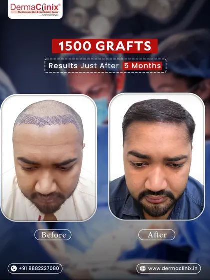 This top down view shows the coverage achieved five months after a 1500 graft hair transplant. Our focus is on creating a natural density that will continue to improve over the coming months.