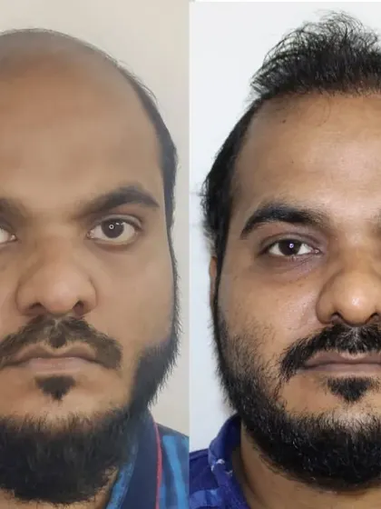 This patient came to me with advanced male pattern baldness. The 'after' photo shows a significant improvement in coverage and a newly defined hairline.