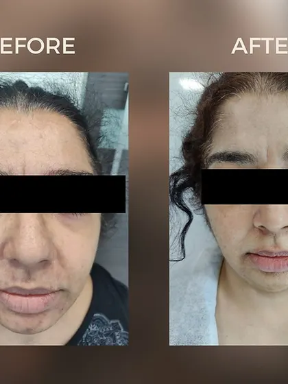 A clear example of our Carbon TriBeam treatment's success in addressing uneven skin tone and texture, resulting in a brighter and more uniform complexion for our client.