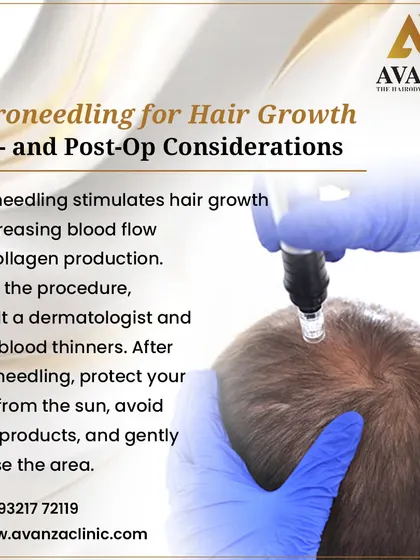 Microneedling is a minimally invasive procedure that stimulates hair growth by increasing blood flow and collagen production in the scalp. We always advise consulting with us before the procedure and following post-op care like sun protection.