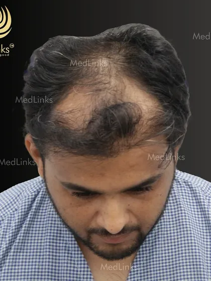This patient was experiencing thinning across the top of his scalp. Our goal was to restore density and create a natural look. The 'before' image shows the extent of the hair loss, a common pattern we treat.