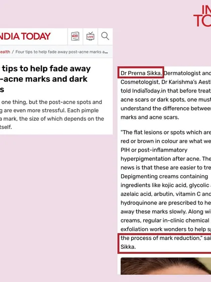 In a feature for India Today, I explained the difference between post-inflammatory hyperpigmentation (PIH) and deeper acne scars. PIH, the flat red or brown spots left after a pimple, can be treated effectively with depigmenting creams and in-clinic chemical peels.