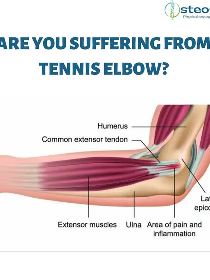 This anatomical illustration shows the tendons affected in Tennis Elbow. The condition results from overloaded tendons due to repetitive wrist and arm motions, common in sports but also in many professions.
