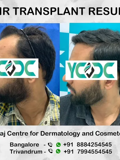 This image captures the change in the patient's profile, where the restored hair provides a stronger and more defined silhouette.