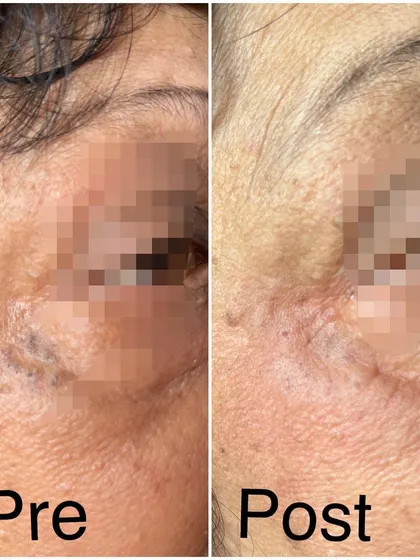 This image shows the before and after of treating senile comedones, which are large, open blackheads common in aging skin. A simple extraction procedure can clear these blemishes in one sitting, instantly improving the skin's appearance.