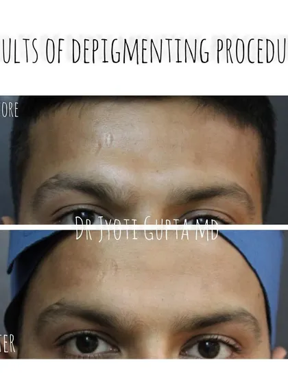 This patient presented with a small, pigmented scar on his forehead. A single session of a depigmenting procedure combined with a skin hydration treatment made a visible difference in the scar's appearance.