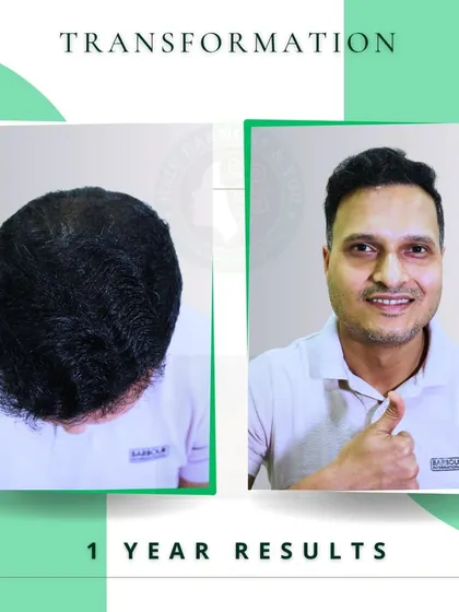 One year later, and the results are incredible. This before and after comparison shows the long-term success of the FUE procedure, with a happy client giving a thumbs-up.