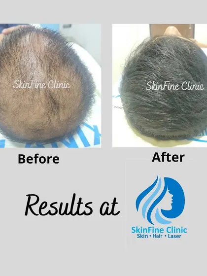 This before and after image shows the result of a 5-month treatment plan for a patient with a 3-year history of hair loss. After a thorough trichoscopic assessment and blood tests, we used a combination of micro-PRP therapy and cyclical supplements to achieve this significant hair regrowth.