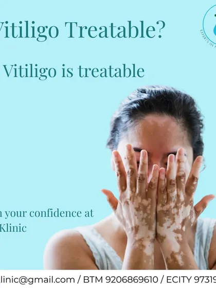 A direct and reassuring message: vitiligo is treatable. We are here to help you regain your confidence with expert dermatological care and personalized treatment plans.