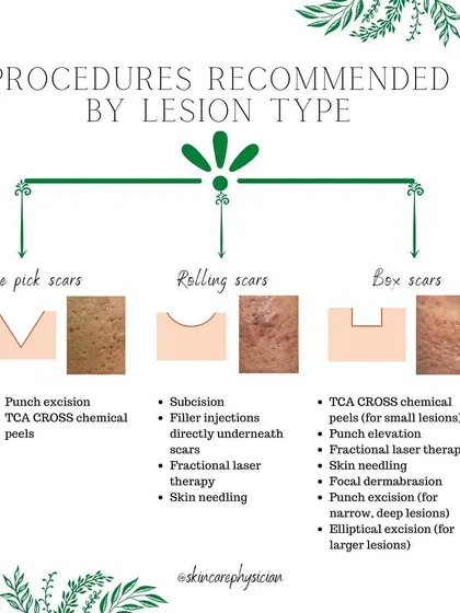 Acne scars require a tailored approach. This chart shows some of the advanced in-clinic procedures I use, such as TCA CROSS peels for ice pick scars and fractional laser for rolling scars, to achieve significant improvement in skin texture.