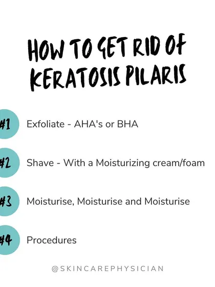 This is my four-step approach to managing keratosis pilaris. It involves gentle exfoliation with AHAs or BHAs, proper shaving technique, consistent moisturizing, and considering in-office procedures for more significant improvement.