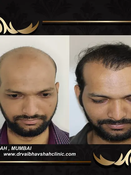 The top-down view of the same patient, confirming the excellent coverage achieved over the entire bald area.