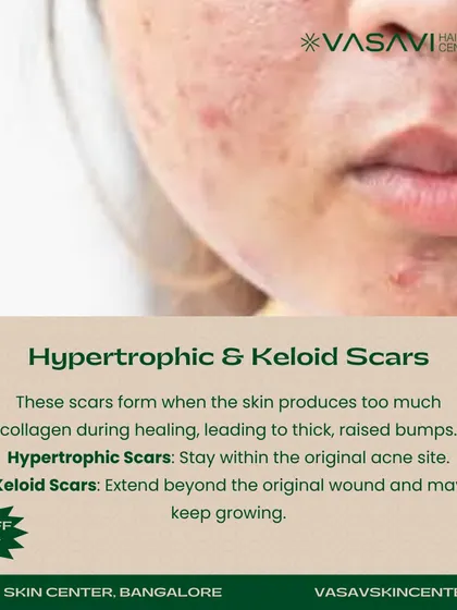 Hypertrophic and keloid scars are the opposite of atrophic scars. They form when the skin produces too much collagen during healing, leading to thick, raised bumps. Hypertrophic scars stay within the original acne site, while keloids can extend beyond it.