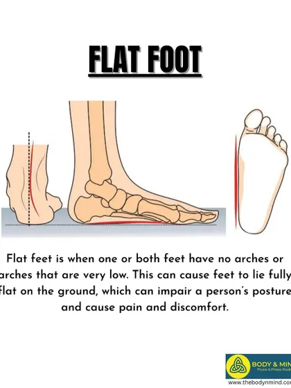 An illustration of a flat foot, where the arch has collapsed. This can cause the foot to roll inward (overpronation), leading to a chain reaction of misalignment and pain up the leg and into the back.