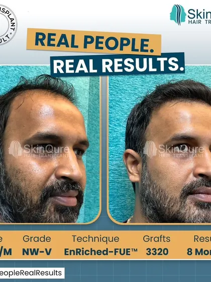 This 36-year-old patient with Norwood Grade V baldness received 3320 grafts. The 8-month result shows a dramatic change, covering a large area of baldness with a natural-looking density that frames his face effectively.
