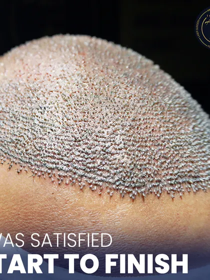 This is where science meets style. A detailed view of newly implanted hair follicles, showcasing the meticulous process of high-density hair restoration.