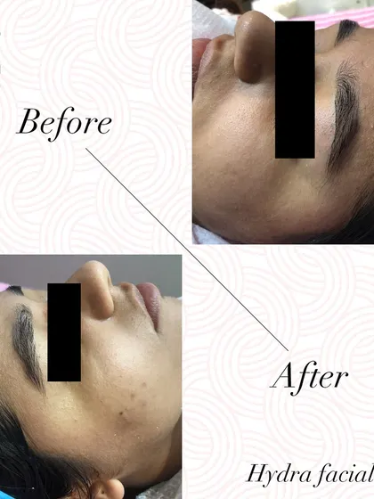Another compelling before and after, showing a noticeable reduction in fine lines and improved skin texture after a HydraFacial.