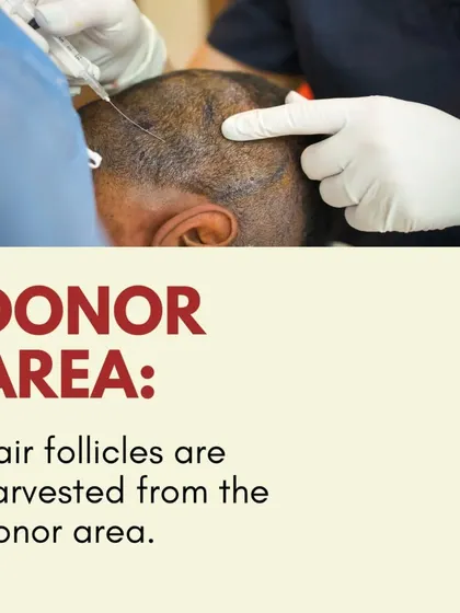 Harvesting Follicles: Using the FUE technique, we carefully harvest individual hair follicles from the donor area, typically the back of the head, ensuring its long-term health.