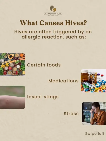 Hives are most often triggered by an allergic reaction. Common culprits include certain foods, medications, and insect stings. In some cases, stress can also be a significant trigger for an urticarial flare.