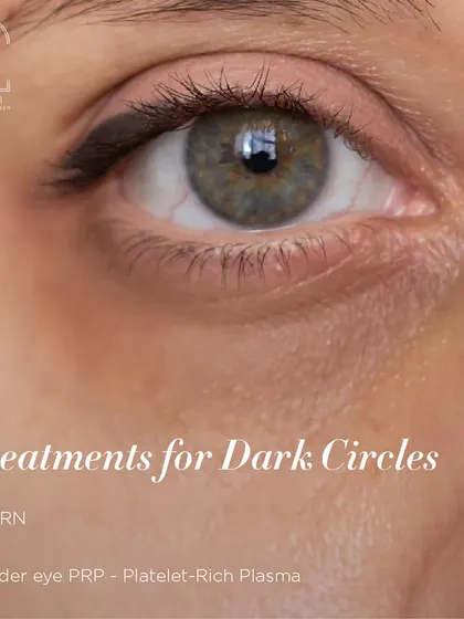 For dark circles, I offer targeted treatments like PDRN and Under-eye PRP to rejuvenate the skin and reduce pigmentation.