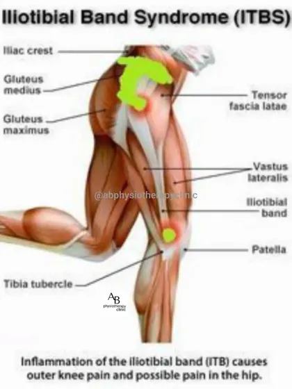 Iliotibial (IT) Band Syndrome is a common cause of outer knee pain, especially in runners. This diagram shows how inflammation of the IT band can cause friction and pain. Our treatment focuses on releasing tightness and strengthening hip muscles to correct the underlying cause.
