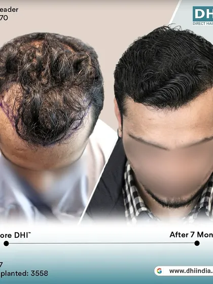 A top-down view of a 27-year-old client 7 months after his procedure. With 3,558 hairs implanted, the transformation in density and coverage is already outstanding.