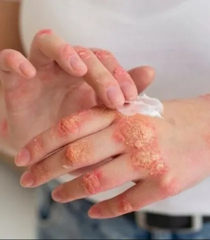 Managing psoriasis requires a holistic approach. I work with my patients to identify their unique triggers and create a sustainable plan that combines medical treatment with lifestyle advice for long-term control and comfort.