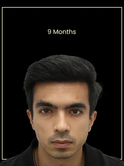 The 9-month result for Gaurav. His hair is thick, natural, and can be styled any way he likes.