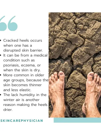 Cracked heels occur when the skin barrier is disrupted, often due to dry skin, medical conditions like eczema, or simply the lack of humidity in the winter air.