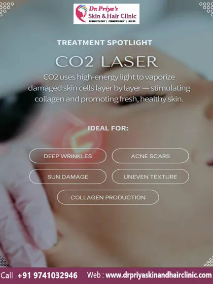 The CO2 laser uses high-energy light to vaporize damaged skin cells layer by layer. This process is ideal for stimulating collagen and addressing deep wrinkles, acne scars, and sun damage.
