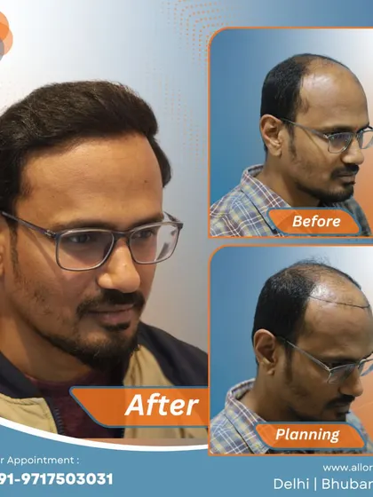 This series shows the meticulous planning phase with hairline marking, the before state, and the remarkable final result. It highlights the importance of a detailed approach to achieve a natural look.
