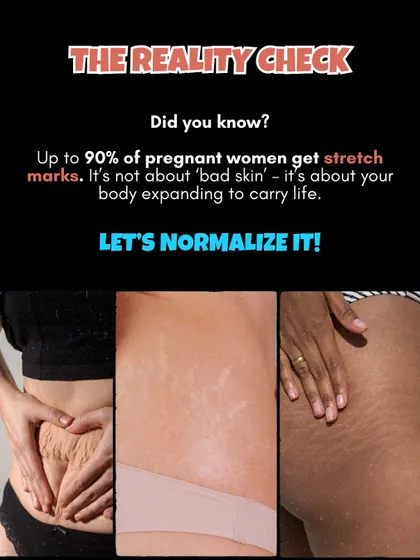 The reality check: Up to 90% of pregnant women get stretch marks. It's not about 'bad skin', it's about your body expanding to carry life. Let's normalize it.