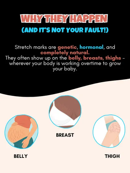 Why do stretch marks happen? It's not your fault. They are genetic, hormonal, and completely natural, appearing wherever your body is working overtime to grow your baby.