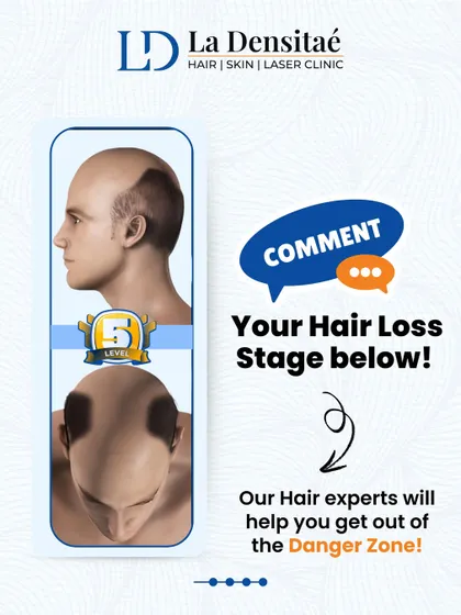 This image focuses on Stage 5 of hair loss, a point where you are in the "Danger Zone." I encourage users to comment with their stage so my expert team can guide them toward the best solution.