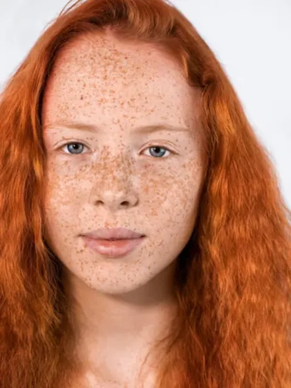 Freckles and lentigines are small brown spots caused by sun exposure. While often harmless, many people wish to lighten them for a more even skin tone. I use treatments like Q-switched lasers to selectively target these spots and fade them effectively.